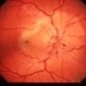 AION With  Ciliotretinal Artery Occlusion AION With  Ciliotretinal Artery Occlusion